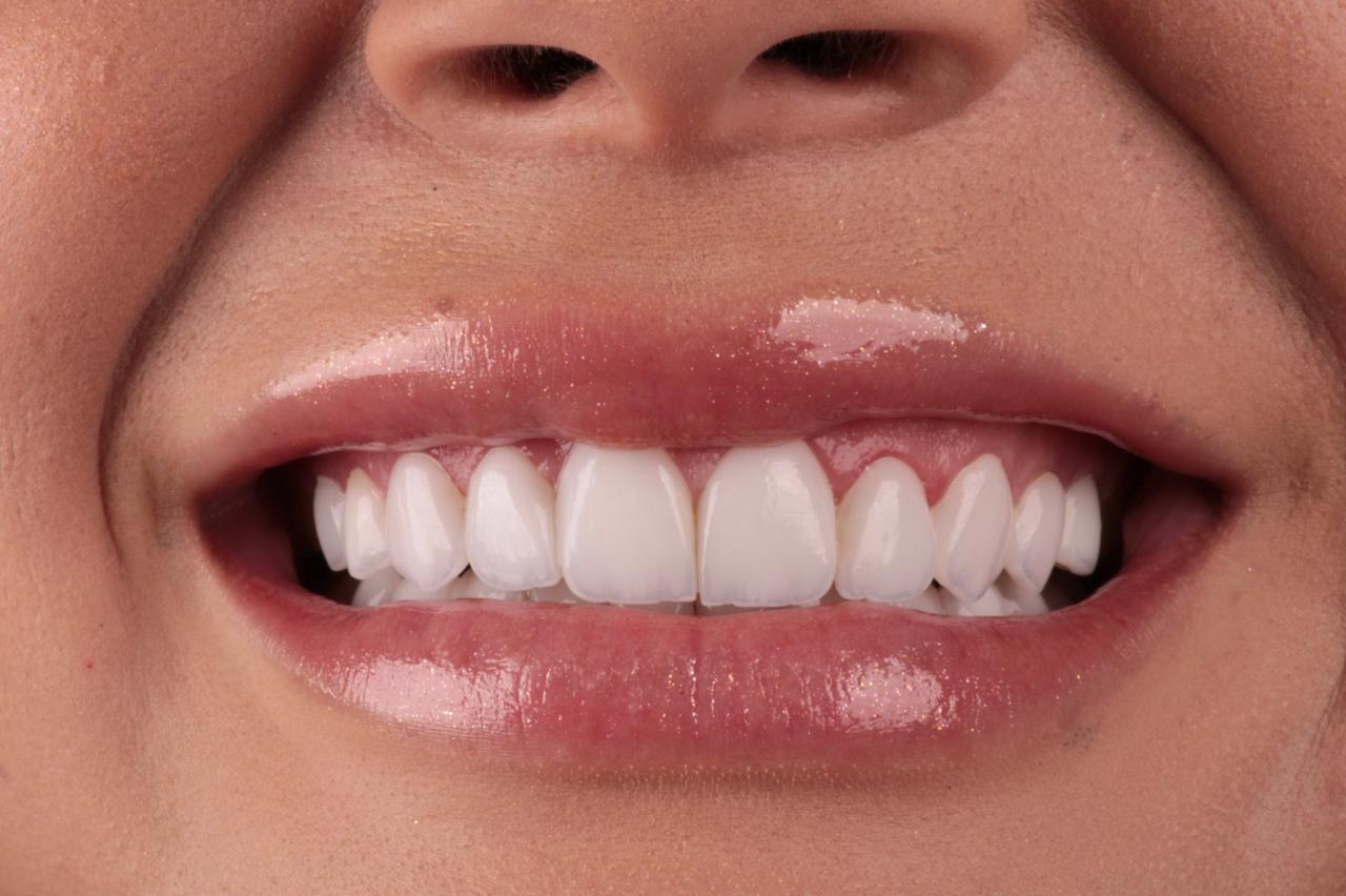 Sorriso depois do tratamento odontológico
