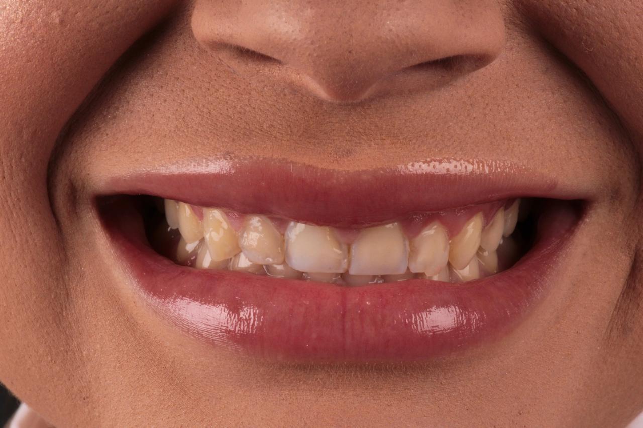 Sorriso antes do tratamento odontológico